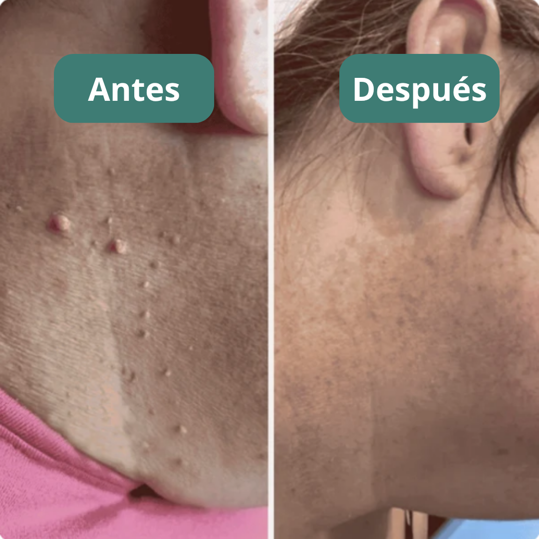 Kit Elimina Verrugas