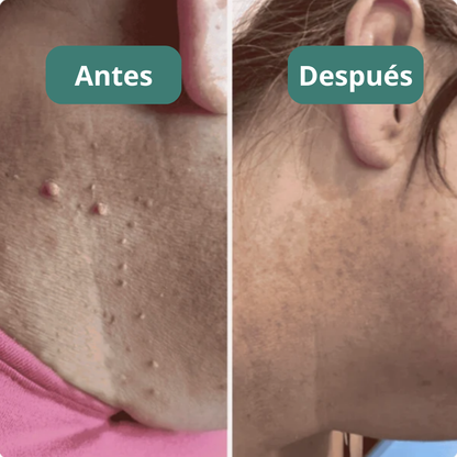 Kit Elimina Verrugas