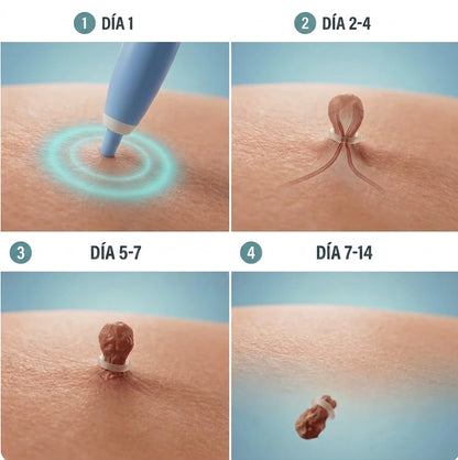 Kit Elimina Verrugas